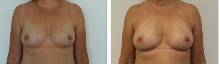 brystforstørrendeoperation med eget fedt